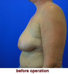 plastic-surgery-breast-lift-augmentation